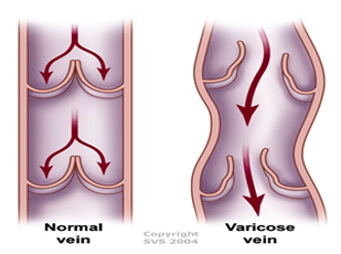 Varicose Vains Diagram.png