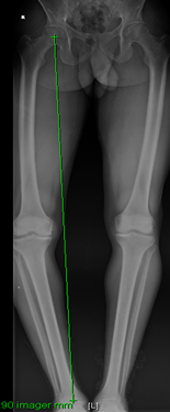 long leg alignmentXR showing bowlegs.png