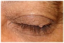 lamp and bump on eyelid (1).jpg