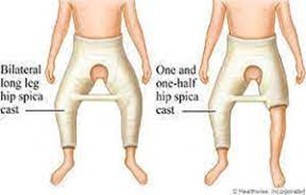 Hip spica.jpg