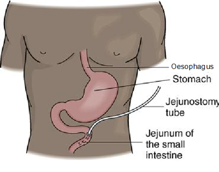 jejunostomy.png