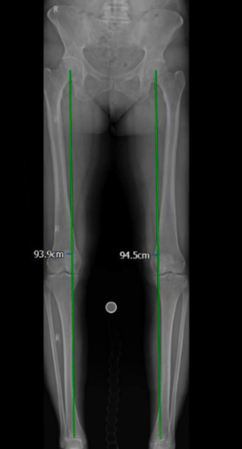 bow legs on XR.png