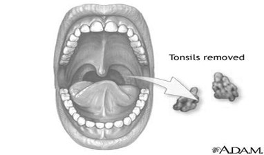 tonsils 1.jpg