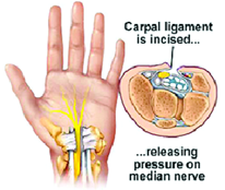 carpal tunnel syndrome 2.png