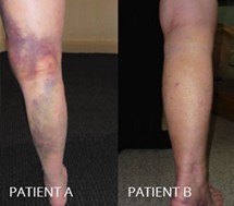 swelling and bruising 2.jpg