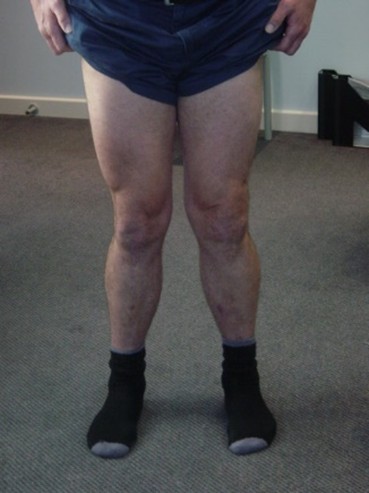 knock knees.jpg