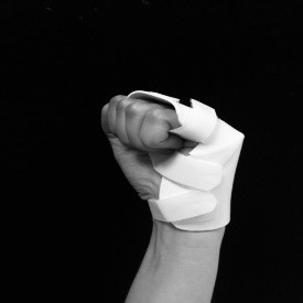 metacarpal fracture exercise 2.jpg