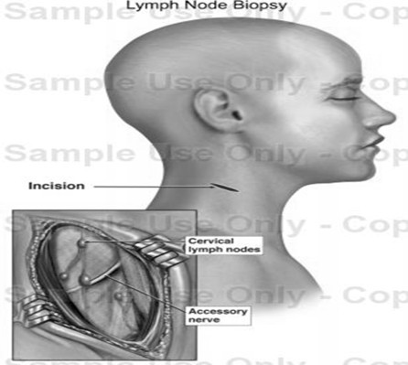 lymphnode1.jpg