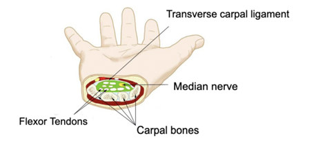 carpal tunnel syndrome.png