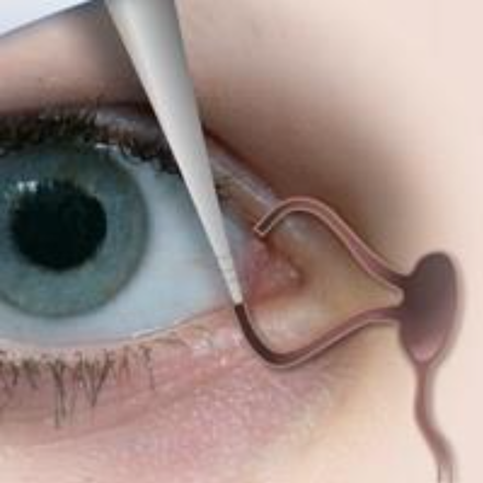 picture of a punctum dilatation.png