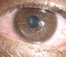 illustration of the corneal allogenic intrastionmal ring segments.png