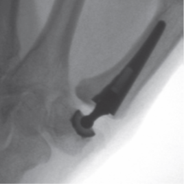 Thumb CMCJ replacement x-ray.png