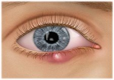 lamp and bump on eyelid (2).jpg
