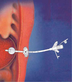 balloon gastrostomy within the stomach.png