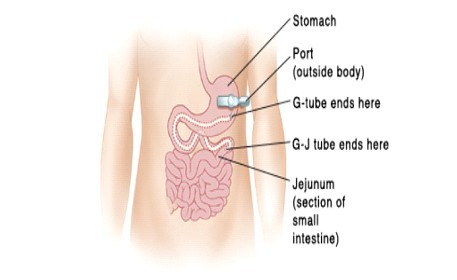 PEG-J feeding.jpg
