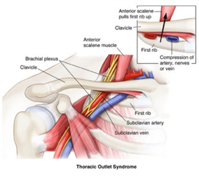 thoracic outlet syndrome.png