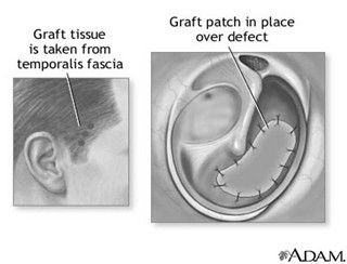 myringoplasty 1.jpg