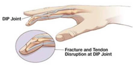 Mallet finger2.png