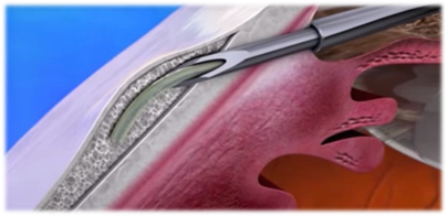 insertion of XEN gel stent into the eye (2).png