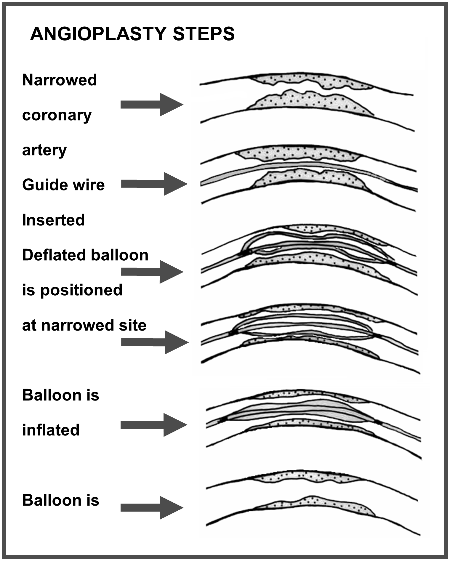 Angioplasty steps.png