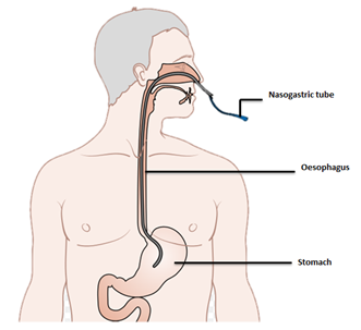 NG tube.png