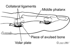 volar plate injury - bedford splint.png