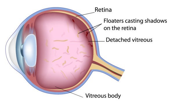 Floaters diagram.jpg