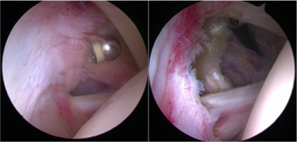 shoulder keyhole surgery.png