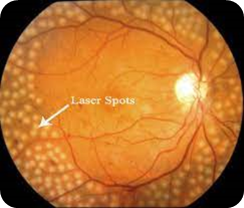 illustration of the laser spots on the retina.png