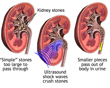 kidney stones 1.png