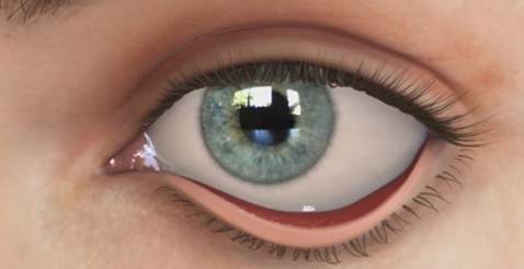 illustration of an eyelid hanging away from eyeball.jpg.png