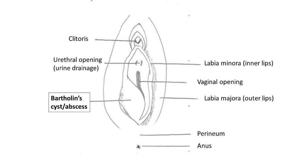 Bartholins cyst.png