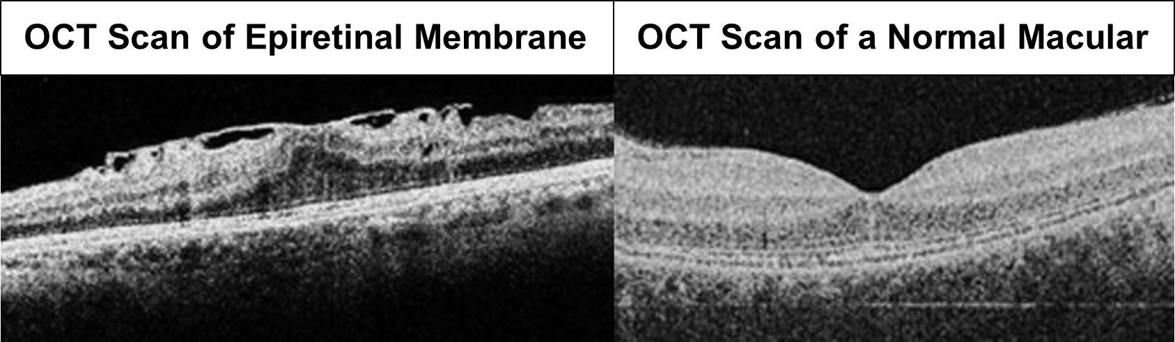 OCT scan of epiretinal membrane and normal macular.png