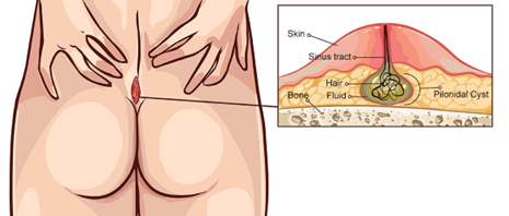pilonidal sinus.png