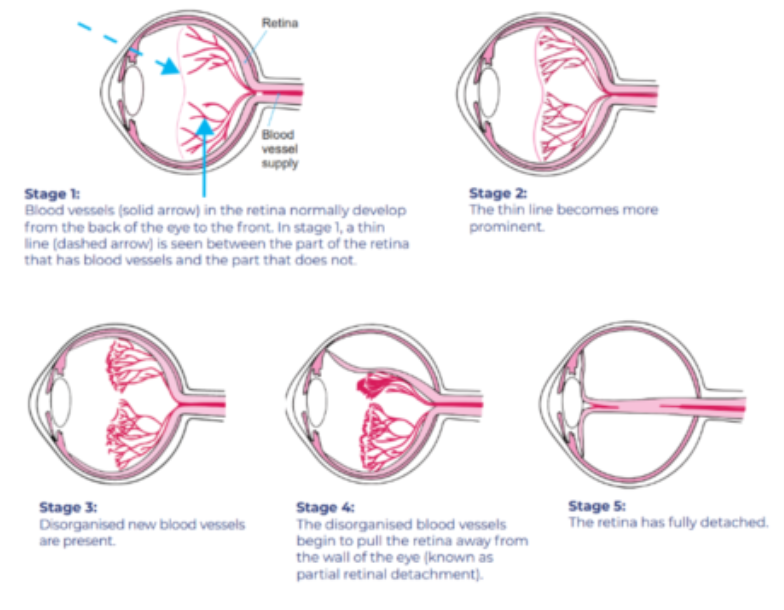 diagrams showing stage 1 to 5 forms of ROP.png