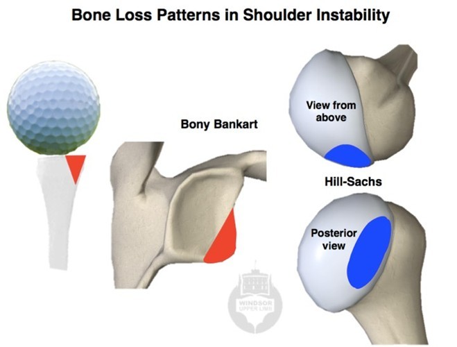 bone loss pattern.jpg