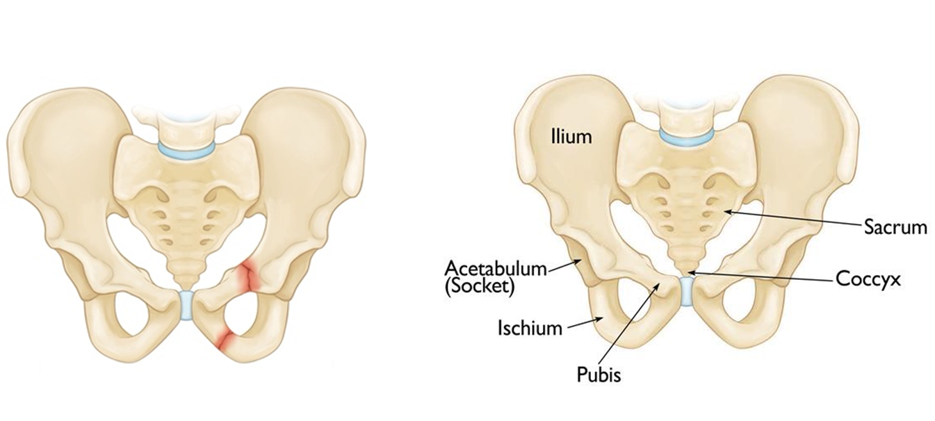 Pubic fracture.png