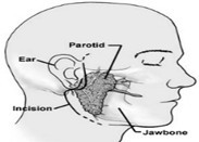 PAROTID1.jpg