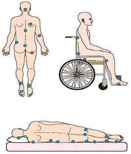 Common pressure ulcers.jpg