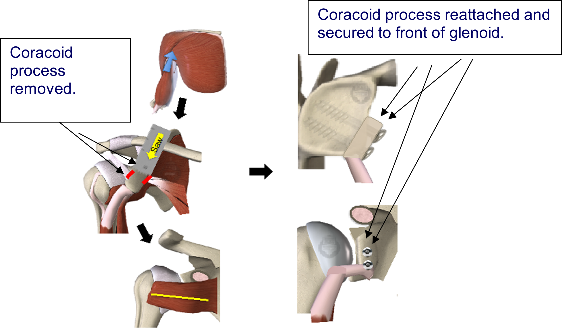 latarjet surgical procedure.png