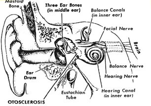otosclerosis 1.jpg