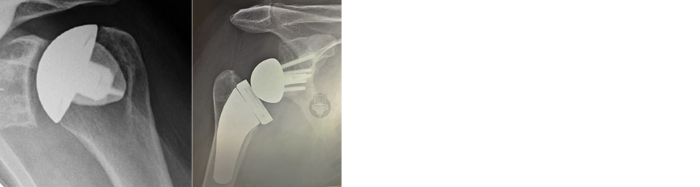total shoulder replacement.png
