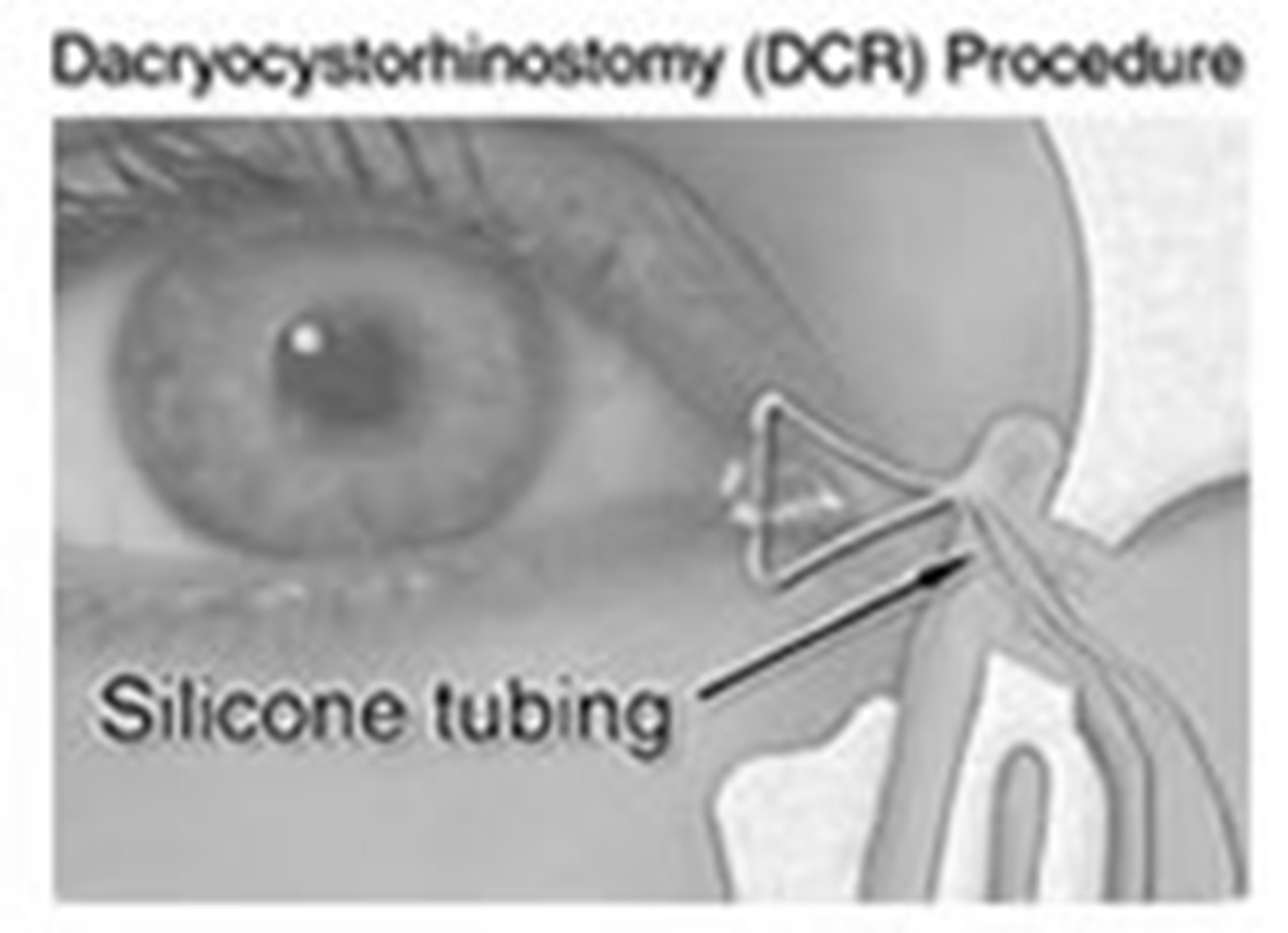 dacrocystorhinostomy1.jpg