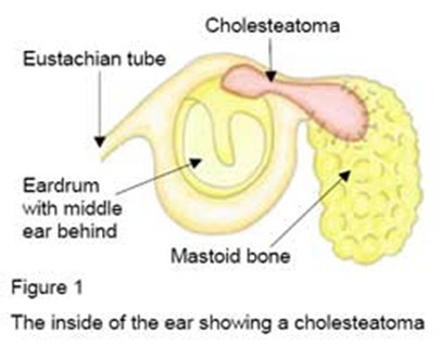 cholesteatoma 1.jpg