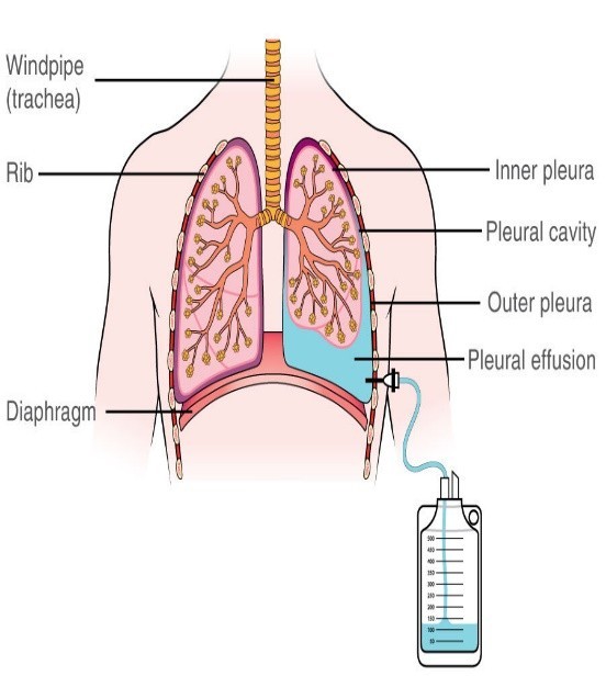 chest drain 2.jpg