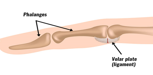 volar plate injury.png