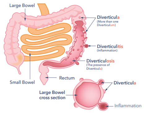 Diverticular 1.png