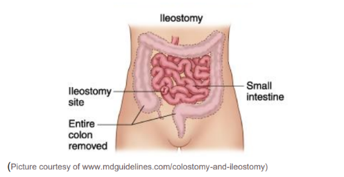 ileostomy.png