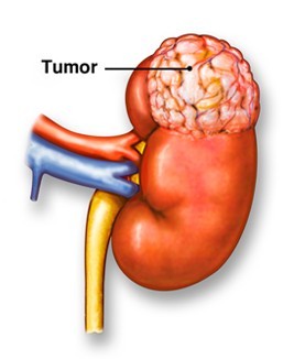 kidney tumor.jpg