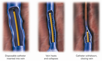 Laser ablation.png